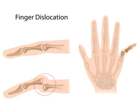 Finger dislocation Illustration