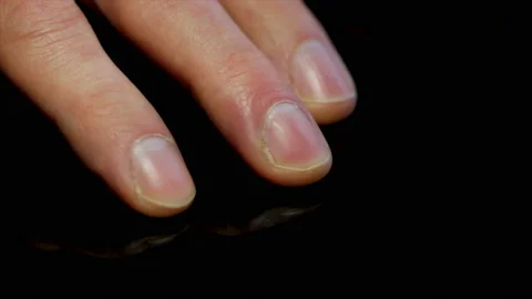 Finger nails close up ingrown nail infection causing swelling by the nail bed. Stock Footage 150510749