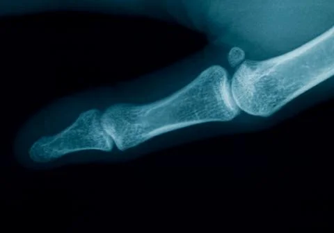 Finger  x-ray Foto stock