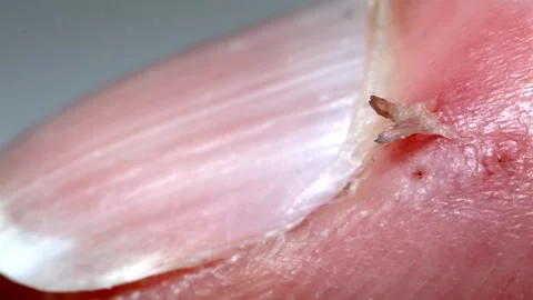 Fingernail Health Problem: Close Up View of Hangnail Skin Detail Vídeos de archivo 306289193