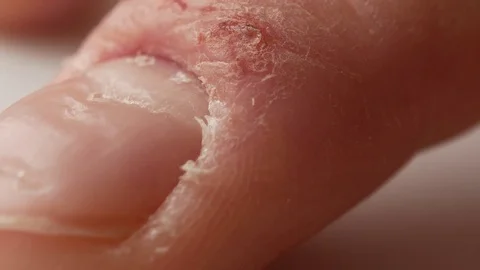 Fingers and nails of a patient with psoriasis. The man nervously knocks the tip Stock Footage