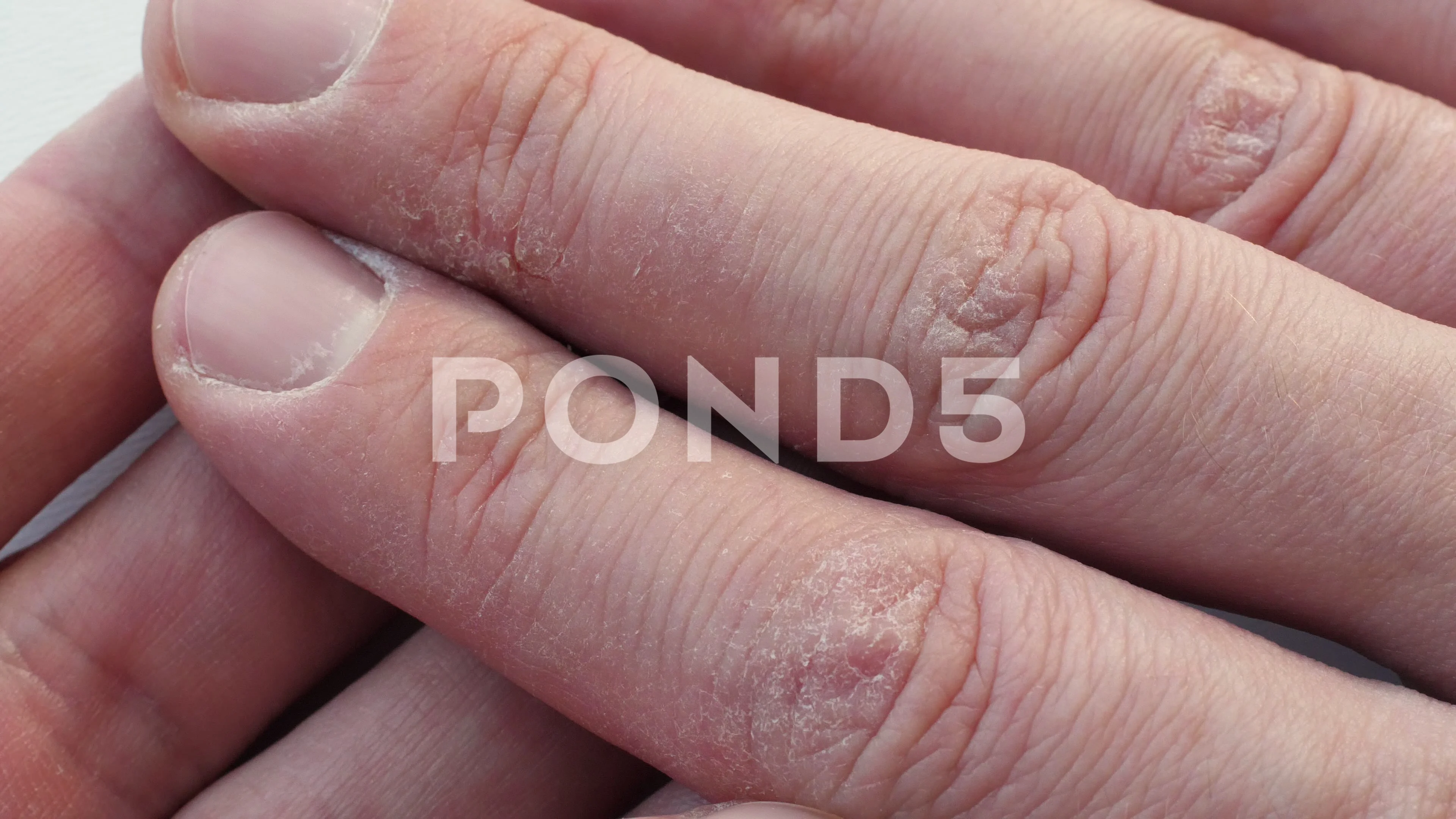 causes-and-treatment-of-swollen-finger-joints