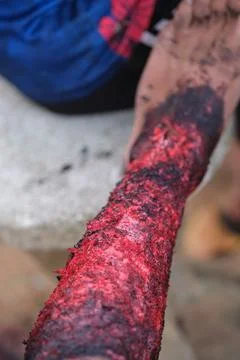 Fire burn makeup special effect Stock Photos