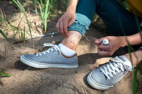 First aid for mosquito bites. Cropped man treat insect bites on ankles with.. Stock Photos