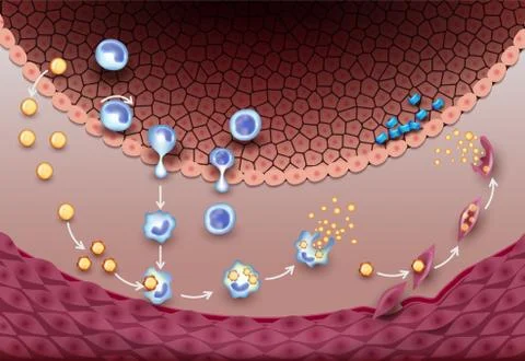 First signs of atherosclerosis Stock Illustration