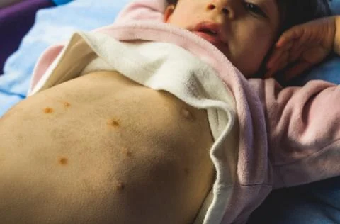 First spots of chicken pox on the baby's tummy Stock Photos