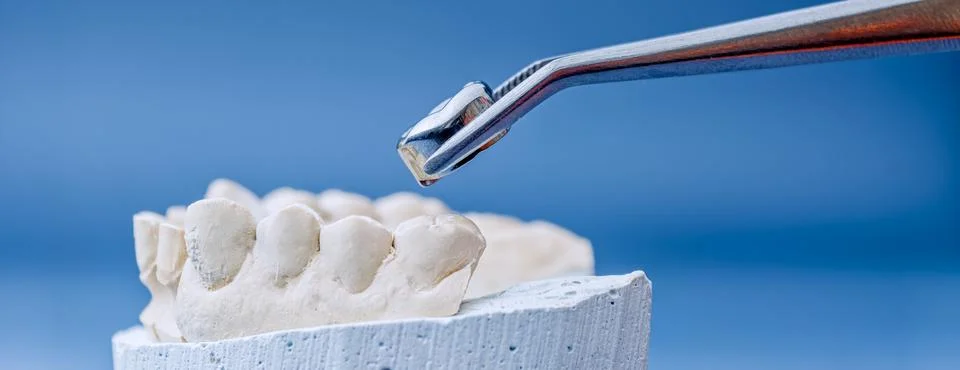 Fitting a dental prosthesis: Macro of artificial crown and plaster cast on bl 스톡 사진