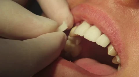 Fitting dental veneers Video stock 61156198