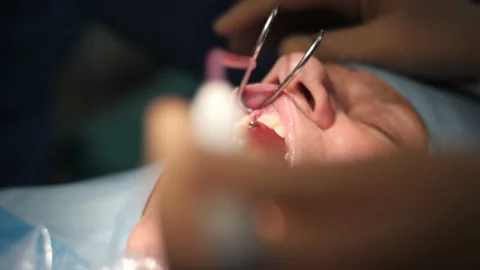 Fitting Impant Bridge and Cleaning Implantation of Patient Stock Footage 148495516