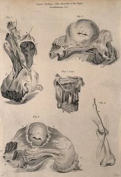 Five examples of aneurisms of the thigh, lettered for key. Etching by D. Li.. Stock Illustration