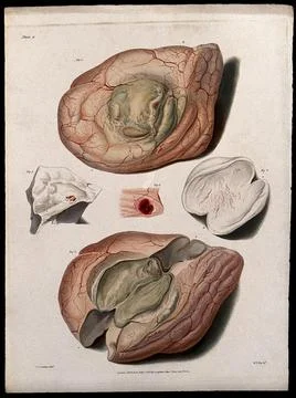 Five sections of diseased brain. Coloured stipple etching by W. T. Fry afte.. Stock Illustration