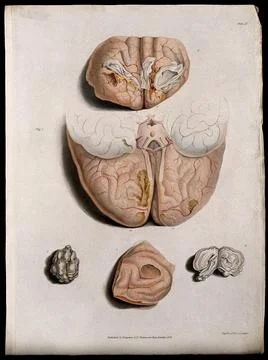 Five sections of diseased brain. Coloured stipple etching by C. J. Canton f.. Stock Illustration