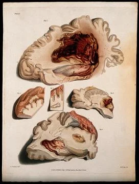 Five sections of diseased brain. Coloured stipple etching by W. T. Fry afte.. Stock Illustration
