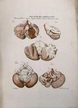 Five sections of diseased brain, numbered for key. Coloured lithograph by B.. Stock Illustration