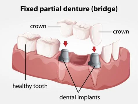 Fixed partial denture bridge Illustrazione stock