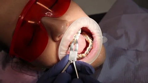 Fixing of the Damon Q bracket system, Dentistry, orthodontics Video stock 156065906