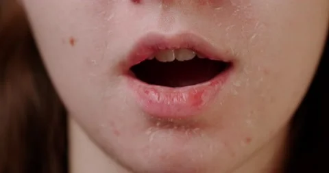 Flaky skin Stock Footage 146480216