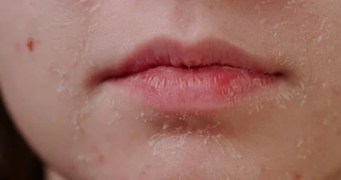 Flaky skin Stock Footage 146480290