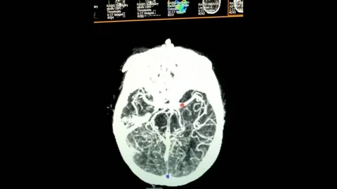 Flashing Brain Perfusion Imaging Scan in Black, White Stock Footage 158900610