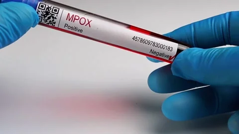 Flasks with blood tests for monkey pox virus positive and negative, mpox Stock Footage 233356331