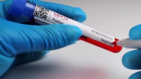 Flasks with blood tests for monkey pox virus positive and negative, mpox Stock Footage 233356332