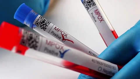 Flasks with blood tests for monkey pox virus positive and negative, mpox Stock Footage 233356338
