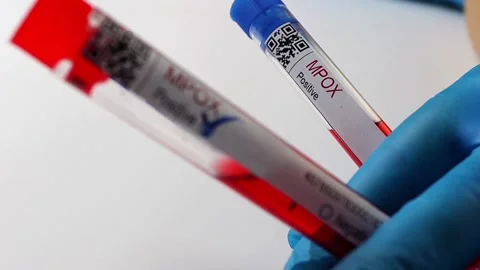 Flasks with blood tests for monkey pox virus positive and negative, mpox Stock Footage 233356348