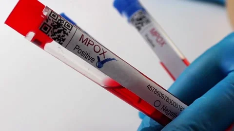 Flasks with blood tests for monkey pox virus positive and negative, mpox Stock Footage 233356349