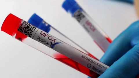 Flasks with blood tests for monkey pox virus positive and negative, mpox Stock Footage 233356354