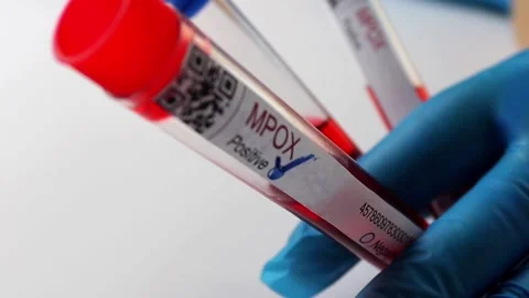Flasks with blood tests for monkey pox virus positive and negative, mpox Stock Footage 233356364