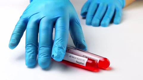 Flasks with blood tests for monkey pox virus positive and negative, mpox Stock Footage 233356386