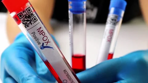Flasks with blood tests for monkey pox virus positive and negative, mpox Stock Footage 233356387