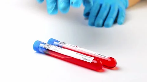 Flasks with blood tests for monkey pox virus positive and negative, mpoxv Stock Footage 233356395