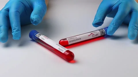 Flasks with blood tests for monkey pox virus positive and negative, mpox Stock Footage 233356398