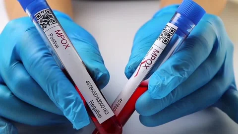 Flasks with blood tests for monkey pox virus positive and negative, mpox Stock Footage 233356427