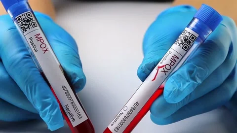 Flasks with blood tests for monkey pox virus positive and negative, mpox Stock Footage 233356429