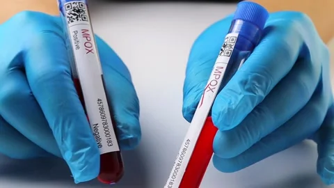 Flasks with blood tests for monkey pox virus positive and negative, mpox Stock Footage 233356432