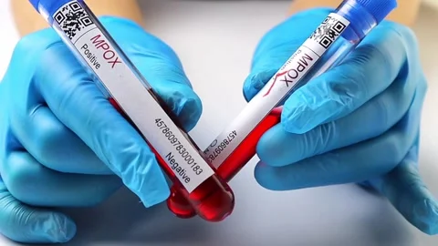 Flasks with blood tests for monkey pox virus positive and negative, mpox Stock Footage 233356433