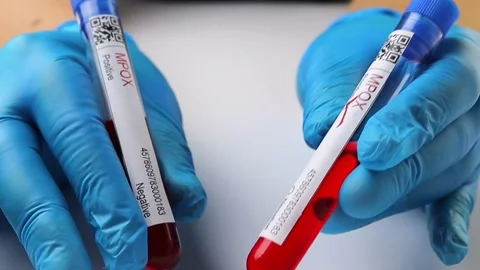 Flasks with blood tests for monkey pox virus positive and negative, mpox Stock Footage 233356446