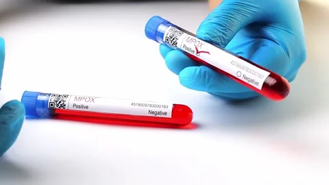 Flasks with blood tests for monkey pox virus positive and negative, mpox Stock Footage 233356479