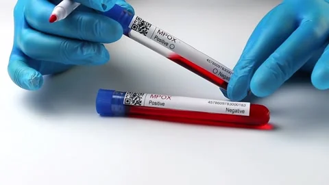Flasks with blood tests for monkey pox virus positive and negative, mpox Stock Footage 233356494