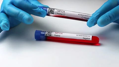 Flasks with blood tests for monkey pox virus positive and negative, mpox Stock Footage 233356499
