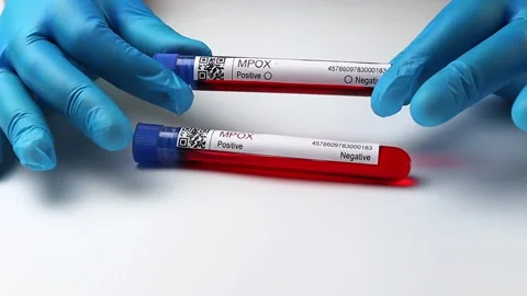 Flasks with blood tests for monkey pox virus positive and negative, mpox Stock Footage 233356500