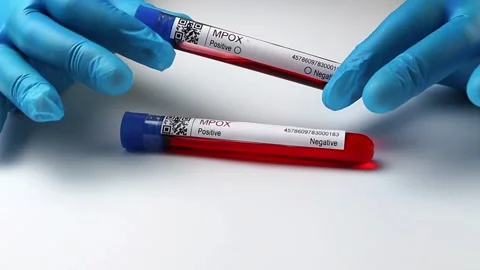 Flasks with blood tests for monkey pox virus positive and negative, mpox Stock Footage 233356509