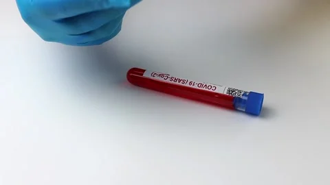 Flasks with blood tests for monkey pox virus positive and negative, mpox Stock Footage 233356575