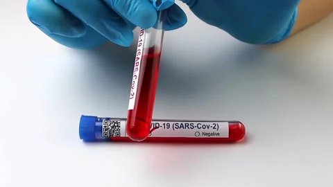 Flasks with blood tests for monkey pox virus positive and negative, mpox Stock Footage 233356577