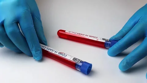 Flasks with blood tests for monkey pox virus positive and negative, mpox Stock Footage 233356580