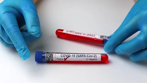 Flasks with blood tests for monkey pox virus positive and negative, mpox Stock Footage 233356591