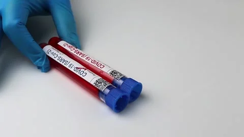 Flasks with blood tests for monkey pox virus positive and negative, mpox Stock Footage 233356597