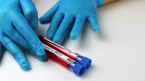 Flasks with blood tests for monkey pox virus positive and negative, mpox Stock Footage 233356599